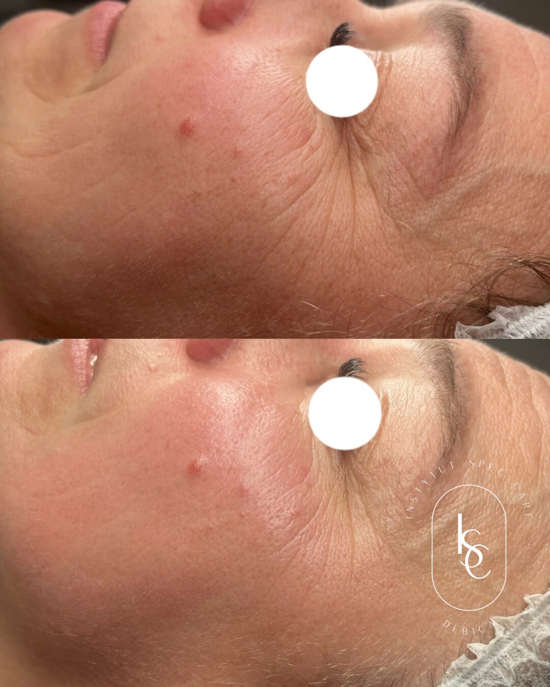 Efekt przed i po. Kosmetolog Dębica